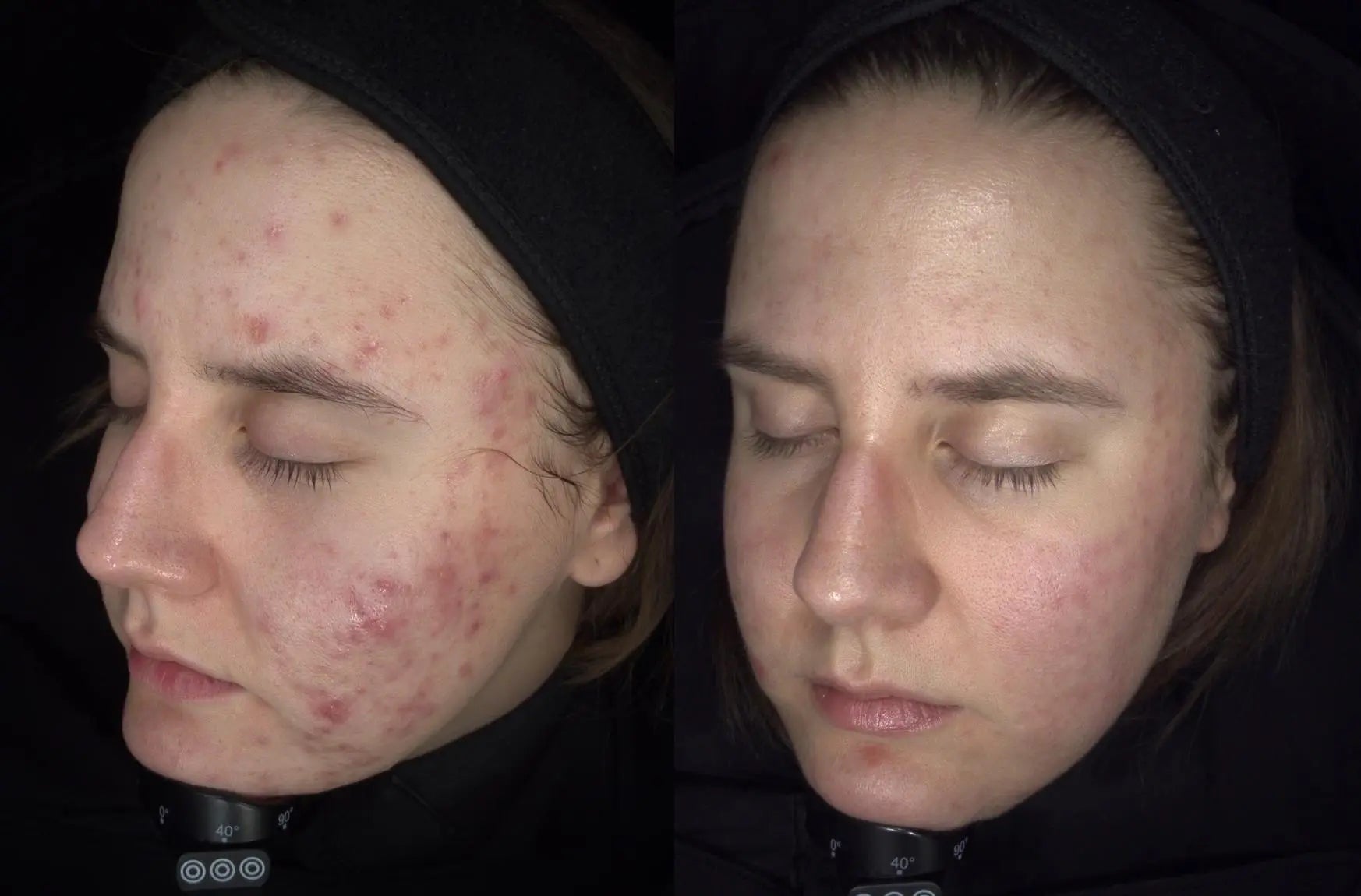 Efekty terapii skóry z trądzikiem hormonalnym i PCOS