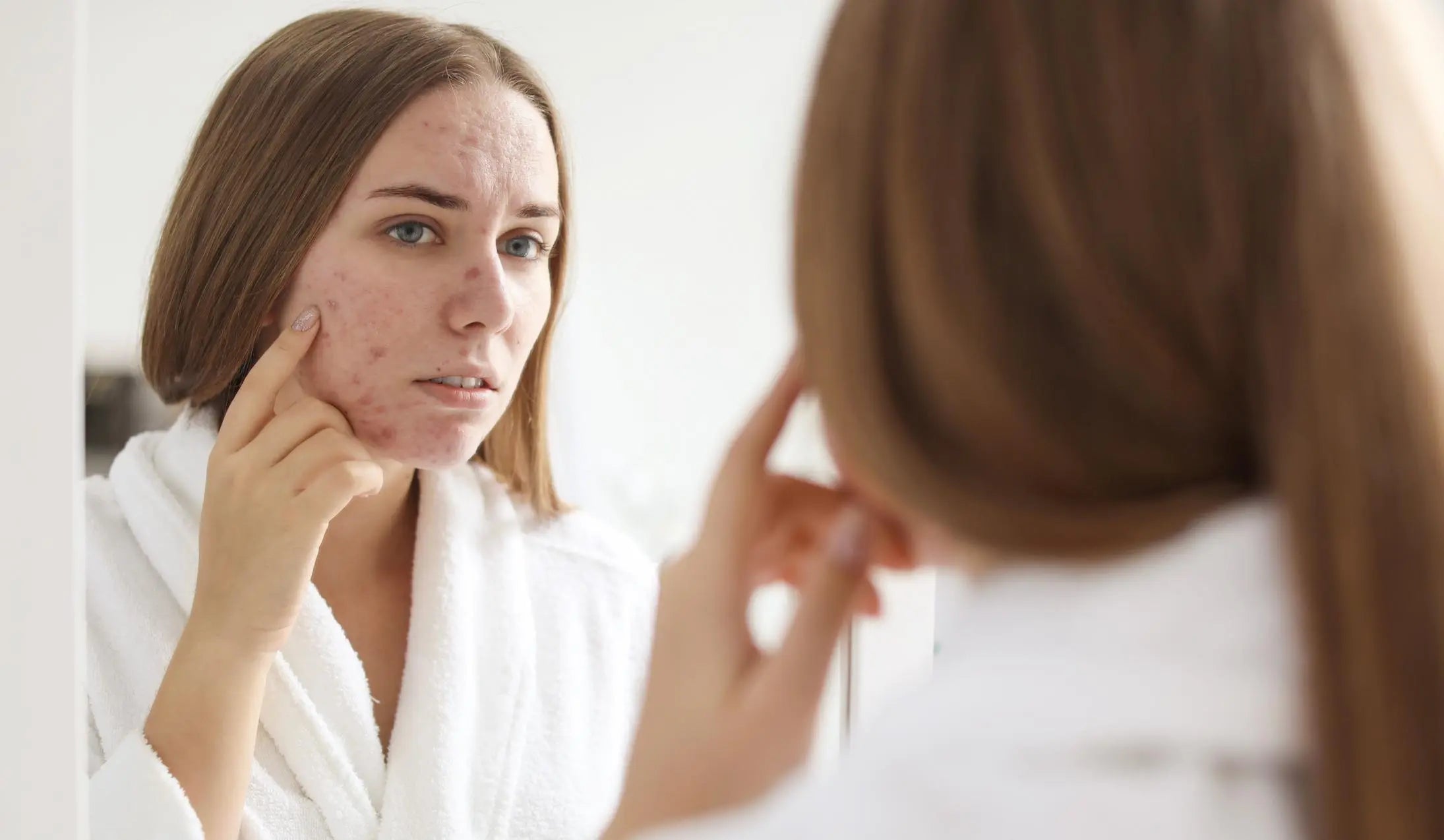 Trądzik pospolity, hormonalny, różowaty - jak je rozpoznać i skutecznie niwelować?