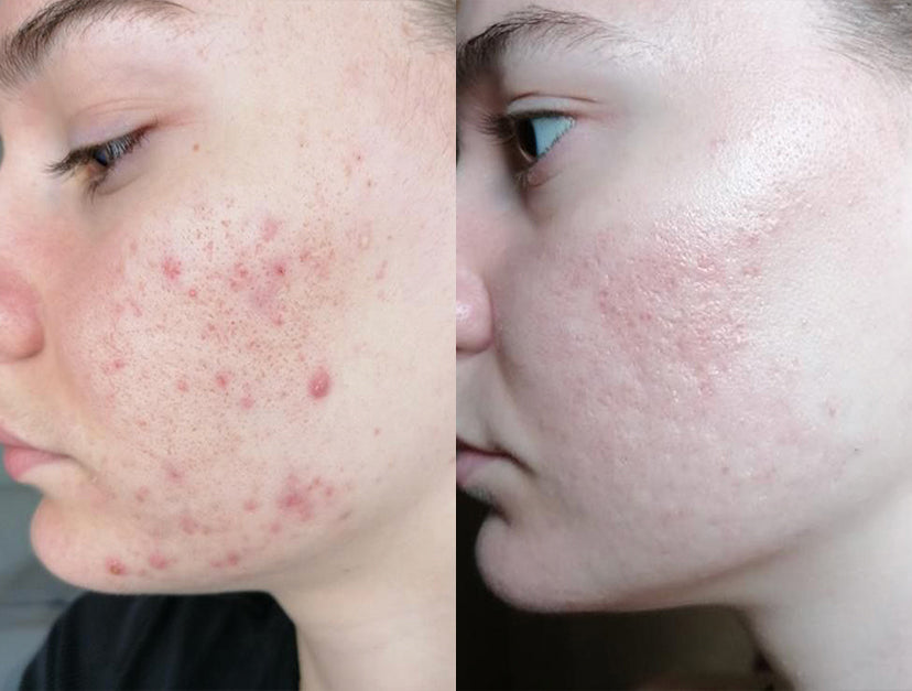 efekty działania dermosuplementu na trądzik acne skin carein