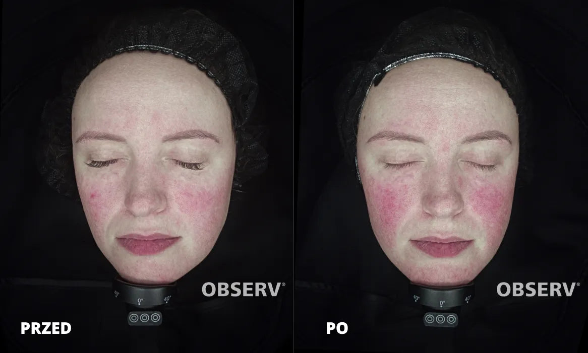 Efekty terapii skóry z trądzikiem różowatym - case study