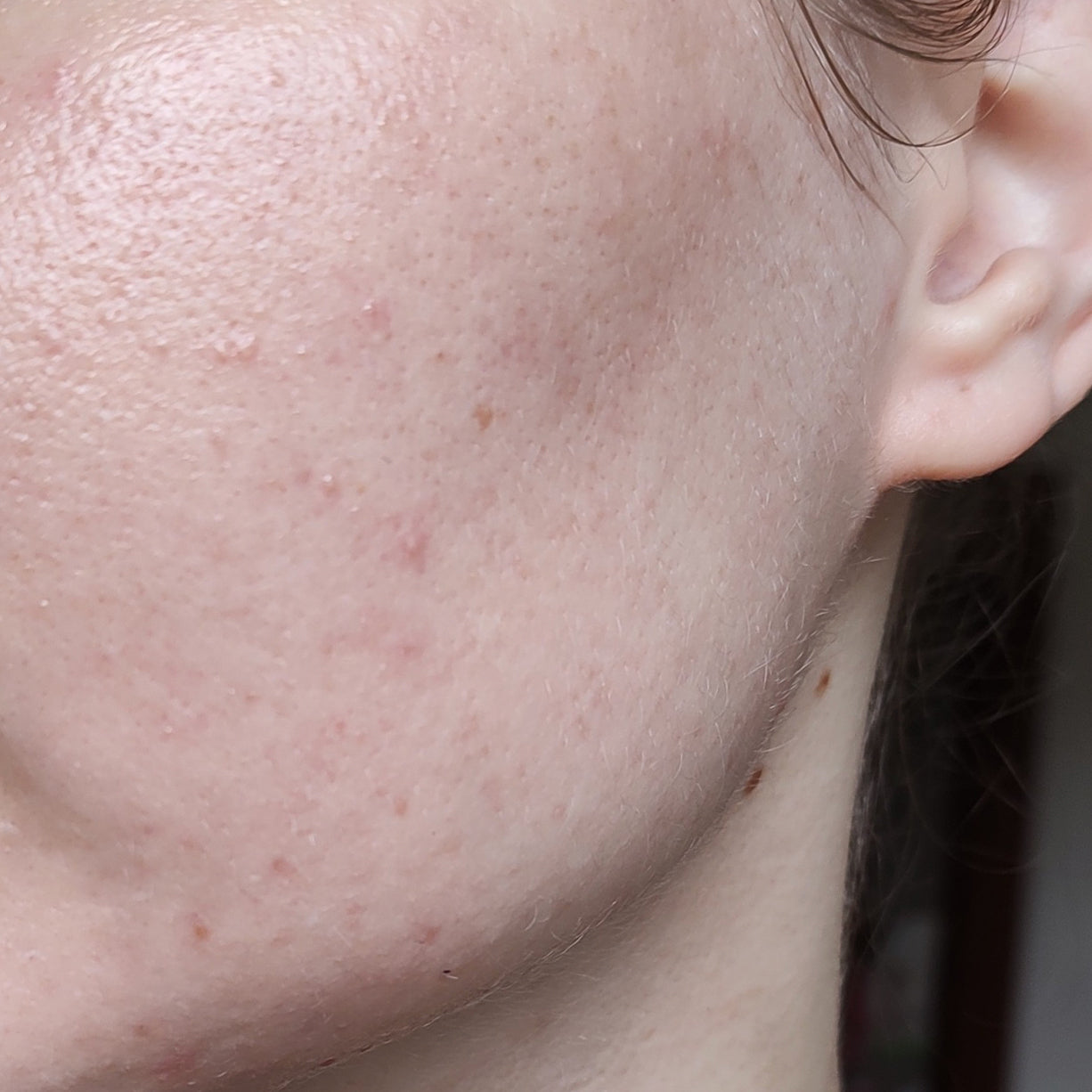 suplement-na-tradzik-acne-skin-metamorfoza-efekty-przed-po
